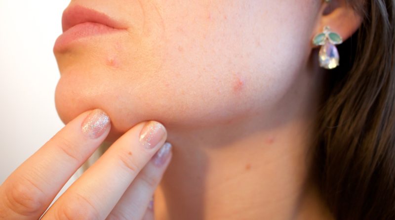 Types of Acne, Causes, and Treatment: Your Ultimate Guide to Healthier Skin [INFOGRAPHIC]